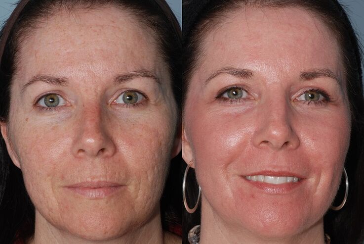 before and after the rejuvenation of the skin of the apparatus