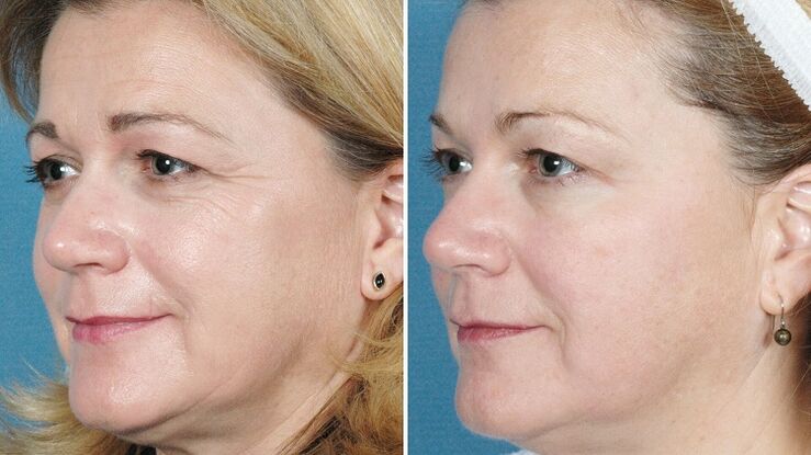 hardware skin rejuvenation photos before and after